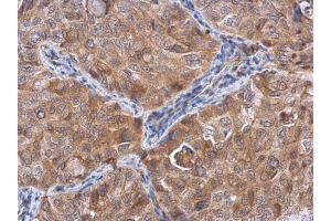 IHC-P Image ACTL8 antibody detects ACTL8 protein at cytoplasm in human lung cancer by immunohistochemical analysis. (Actin-Like 8 anticorps)