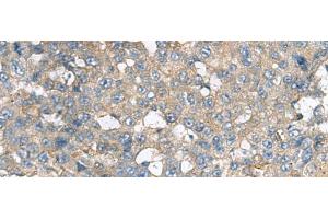 Immunohistochemistry of paraffin-embedded Human liver cancer tissue using CXCR5 Polyclonal Antibody at dilution of 1:80(x200) (CXCR5 anticorps)