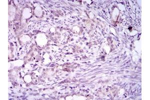 Immunohistochemical analysis of paraffin-embedded cervical cancer tissues using ITGA2B mouse mAb with DAB staining.
