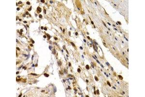 Immunohistochemistry of paraffin-embedded Human colon damage using TFDP1 Polyclonal Antibody at dilution of 1:200 (40x lens). (DP1 anticorps)