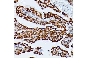 Immunohistochemistry of paraffin-embedded human thyroid cancer using IDH3A antibody (ABIN7268029) at dilution of 1:100 (40x lens).