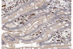 ABIN6266583 at 1/100 staining human colon carcinoma tissue sections by IHC-P. (SCGB2A1 anticorps  (Internal Region))