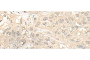 Immunohistochemistry of paraffin-embedded Human esophagus cancer tissue using CYP4X1 Polyclonal Antibody at dilution of 1:40(x200) (CYP4X1 anticorps)