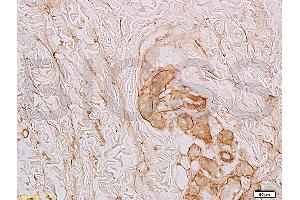 Formalin-fixed and paraffin embedded human skin labeled with Anti-Collagen-VI-alpha1 Polyclonal Antibody (ABIN670011), Unconjugated at 1:100, followed by conjugation to the secondary antibody and DAB staining