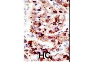 Formalin-fixed and paraffin-embedded human cancer tissue reacted with the primary antibody, which was peroxidase-conjugated to the secondary antibody, followed by AEC staining.