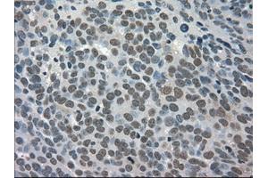 Immunohistochemical staining of paraffin-embedded Adenocarcinoma of breast tissue using anti-TRIB2 mouse monoclonal antibody.