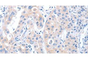 Immunohistochemistry of paraffin-embedded Human lung cancer tissue using ARHGEF6 Polyclonal Antibody at dilution 1:70 (ARHGEF6 anticorps)