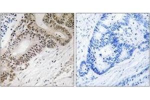 Immunohistochemistry analysis of paraffin-embedded human colon carcinoma tissue, using FOXO3A (Ab-315) Antibody.