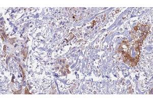 ABIN6269237 at 1/100 staining Human urothelial cancer tissue by IHC-P. (CD130/gp130 anticorps  (C-Term))