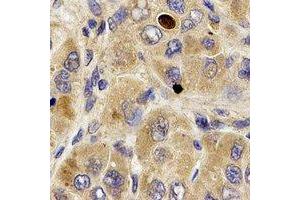 Immunohistochemical analysis of MPP2 staining in human liver cancer formalin fixed paraffin embedded tissue section. (MPP2 anticorps)