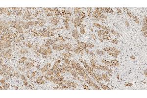 Invasive breast carcinoma: immunohistochemical staining for E-Cadherin.