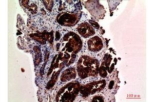 Immunohistochemistry (IHC) analysis of paraffin-embedded Human Prostate Cancer, antibody was diluted at 1:100. (Prostate Specific Antigen anticorps  (Internal Region))