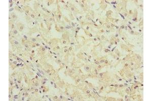 Immunohistochemistry of paraffin-embedded human gastric cancer using ABIN7147407 at dilution of 1:100 (CEP44 anticorps  (AA 1-280))