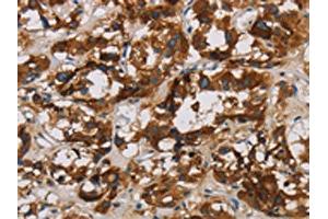 The image is immunohistochemistry of paraffin-embedded Human thyroid cancer tissue using ABIN7128636(BCL2L12 Antibody) at dilution 1/20. (BCL2L12 anticorps)