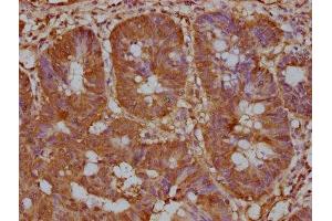 IHC image of ABIN7139920 diluted at 1:200 and staining in paraffin-embedded human colon cancer performed on a Leica BondTM system.