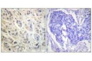 Immunohistochemistry analysis of paraffin-embedded human colon carcinoma tissue using p90 RSK (Ab-573) antibody.