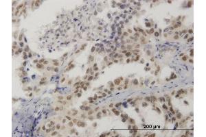 Immunoperoxidase of monoclonal antibody to HMG20B on formalin-fixed paraffin-embedded human lung cancer.