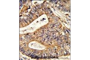 Formalin-fixed and paraffin-embedded human colon carcinoma reacted with CALR Antibody (Center), which was peroxidase-conjugated to the secondary antibody, followed by DAB staining.