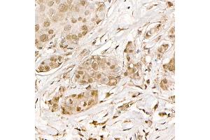 Immunohistochemistry of paraffin-embedded human breast cancer using [KO Validated] β-Catenin Mouse mAb (ABIN7266137) at dilution of 1:200 (40x lens).