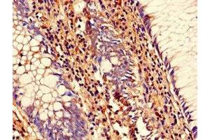 Immunohistochemistry of paraffin-embedded human colon cancer using ABIN7168833 at dilution of 1:100 (SENP1 anticorps  (AA 63-214))