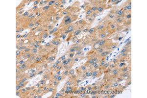 Immunohistochemistry of Human liver cancer using ERVW-1 Polyclonal Antibody at dilution of 1:45 (ERVW-1 anticorps)