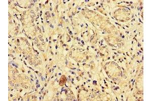 Immunohistochemistry of paraffin-embedded human gastric cancer using ABIN7151827 at dilution of 1:100 (EPHA1 anticorps  (AA 296-414))