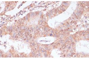 Immunohistochemistry of paraffin-embedded Human colon carcinoma using BYSL Polyclonal Antibody at dilution of 1:100 (40x lens). (Bystin-Like anticorps)