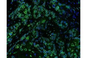 IF analysis of Emerin using anti-Emerin antibody (ABIN4886569) Emerin was detected in paraffin-embedded section of human oesophagus squama cancer tissues. (Emerin anticorps  (N-Term))