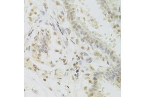 Immunohistochemistry of paraffin-embedded human breast using PRPF3 Antibody. (PRPF3 anticorps  (AA 1-280))