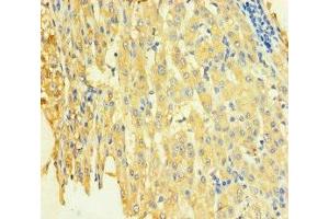 Immunohistochemistry of paraffin-embedded human liver cancer using ABIN7171249 at dilution of 1:100 (STX8 anticorps  (AA 1-215))
