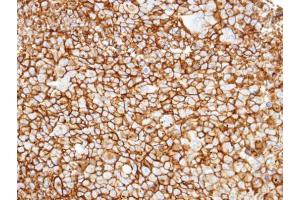 IHC-P Image Immunohistochemical analysis of paraffin-embedded H1299 xenograft, using CD13, antibody at 1:100 dilution. (CD13 anticorps)