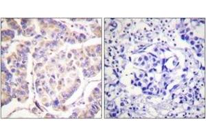 Immunohistochemistry analysis of paraffin-embedded human breast carcinoma tissue, using SYK (Ab-525) Antibody. (SYK anticorps  (AA 491-540))