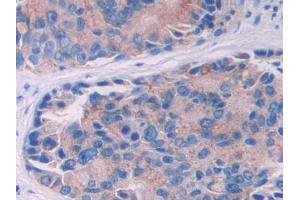 Detection of IL10Ra in Human Prostate cancer Tissue using Polyclonal Antibody to Interleukin 10 Receptor Alpha (IL10Ra) (IL-10RA anticorps  (AA 132-235))