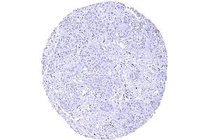 Muscle invasive urothelial carcinoma of the urinary bladder.