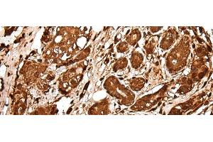 Immunohistochemistry of paraffin-embedded Human breast cancer tissue using VCP Polyclonal Antibody at dilution of 1:30(x200) (VCP anticorps)
