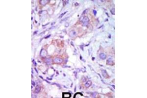 Formalin-fixed and paraffin-embedded human cancer tissue reacted with the primary antibody, which was peroxidase-conjugated to the secondary antibody, followed by DAB staining. (MAP3K9 anticorps  (C-Term))
