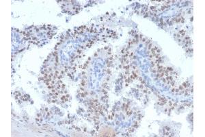 Formalin-fixed, paraffin-embedded human prostate carcinoma stained with RET Mouse Monoclonal Antibody (RET/2663).