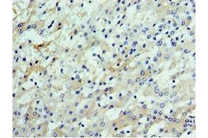 Immunohistochemistry of paraffin-embedded human liver cancer using ABIN7147929 at dilution of 1:100 (CSTF2 anticorps  (AA 1-180))