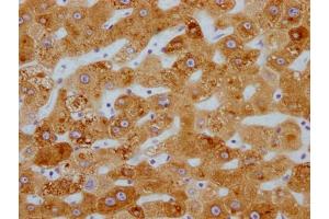IHC image of ABIN7127448 diluted at 1:100 and staining in paraffin-embedded human liver cancer performed on a Leica BondTM system.