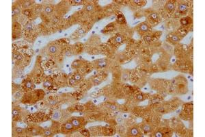 IHC image of ABIN7127448 diluted at 1:100 and staining in paraffin-embedded human liver cancer performed on a Leica BondTM system. (Recombinant CYP3A4 anticorps)