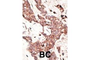 Formalin-fixed and paraffin-embedded human cancer tissue reacted with the primary antibody, which was peroxidase-conjugated to the secondary antibody, followed by AEC staining.