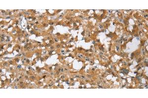 Immunohistochemistry of paraffin-embedded Human thyroid cancer tissue using MMP12 Polyclonal Antibody at dilution of 1:60 (MMP12 anticorps)