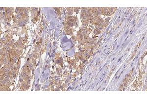 ABIN6266830 at 1/100 staining Human Melanoma tissue by IHC-P. (COL4A1 anticorps)