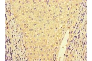 Immunohistochemistry of paraffin-embedded human liver cancer using ABIN7156891 at dilution of 1:100 (IL32 anticorps  (AA 31-234))