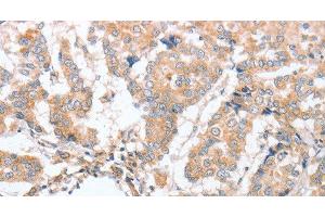 Immunohistochemistry of paraffin-embedded Human breast cancer tissue using PARD6A Polyclonal Antibody at dilution 1:60 (PARD6A anticorps)