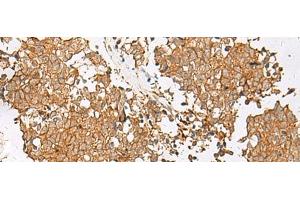 Immunohistochemistry of paraffin-embedded Human lung cancer tissue using GSTM2 Polyclonal Antibody at dilution of 1:50(x200) (GSTM2 anticorps)