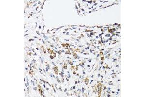 Immunohistochemistry of paraffin-embedded human uterine cancer using DHRS2 antibody. (DHRS2 anticorps  (AA 1-300))