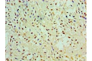 Immunohistochemistry of paraffin-embedded human breast cancer using ABIN7151444 at dilution of 1:100