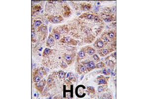 Formalin-fixed and paraffin-embedded human hepatocellular carcinoma reacted with FDPS polyclonal antibody  , which was peroxidase-conjugated to the secondary antibody, followed by DAB staining . (FDPS anticorps  (AA 338-453))