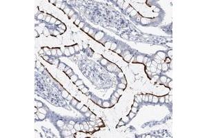 Immunohistochemical staining of human colon with VILL polyclonal antibody  shows strong luminal membrane positivity in glandular cells at 1:50-1:200 dilution. (VILL anticorps)